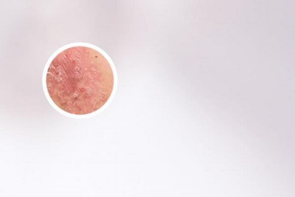 长春看银屑病医院哪个好-长春治疗银屑病正规专业医院