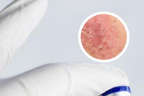 长春哪里的医院可以治白癜风-长春中医治白癜风正规医院