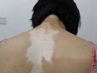 在长春治白癜风哪家医院效果好-长春什么医院治白癜风疗效好