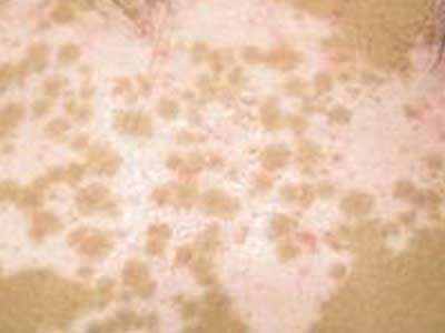 长春看白癜风的专业医院-长春什么医院看白癜风效果好