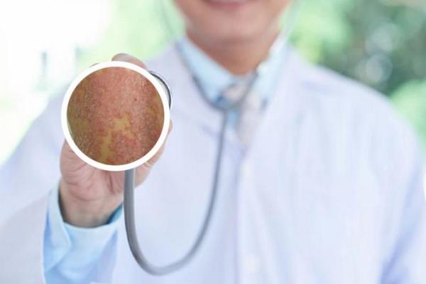 长春治银屑病到哪家医院正规-长春治疗银屑病哪家好