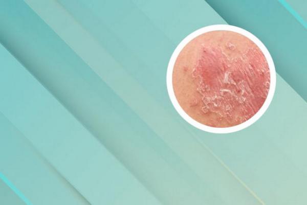 长春有哪些是专治银屑病的医院-长春好的银屑病医院