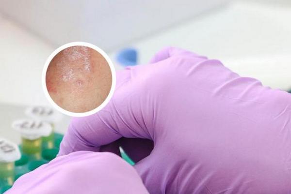 长春什么医院治疗银屑病效果好-长春看银屑病医院哪个专业