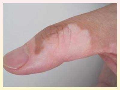 长春治白癜风哪里好啊-长春哪家医院治疗白癜风好点