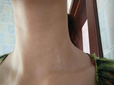 长春怎么才能治好白癜风-长春哪里医院看白癜风可以