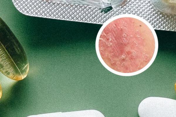 长春哪家银屑病看得好-长春银屑病医院哪个正规